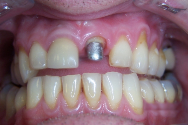 Implant - Before
