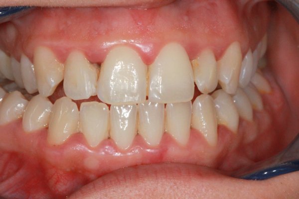 Discoloured anterior composites replaced after cosmetic teeth whitenning and peridontal treatment.