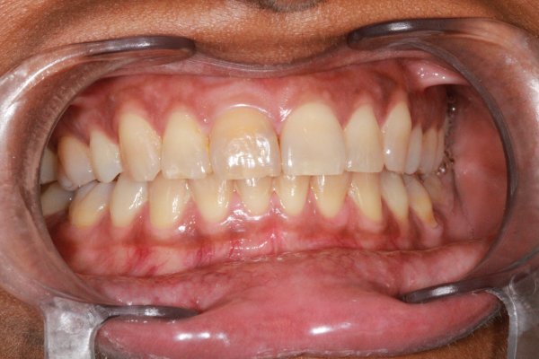 Discoloured root filled UR1 whitened with internal and external bleaching.