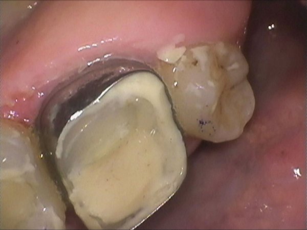 Cracked tooth, restored with a root filling and precious metal alloy crown.