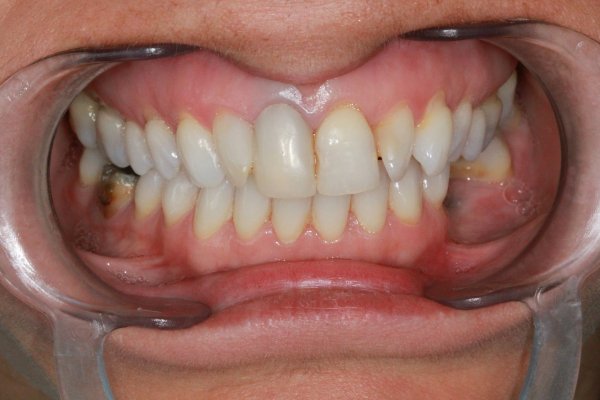 UR1 crown replaced with an all ceramic zirconia crown and root filled with a metal post/core.
