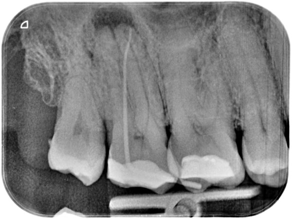 UR7 periapical infection treated with a root filling.