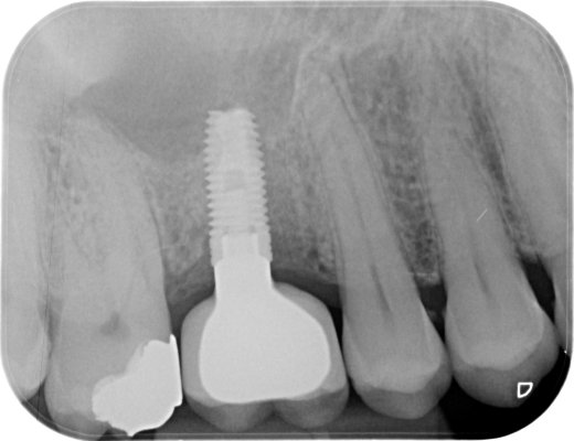 Missing UR6 restored with a  screw retained implant/crown.