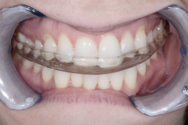 An upper Michigan hard acrylic occlusal splint providing protection from dental parafunctioning.